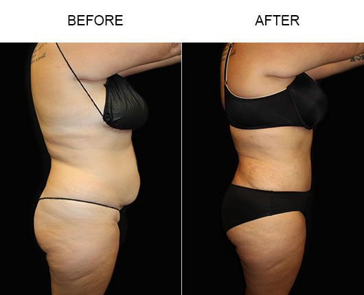LowCut Abdominoplasty Results