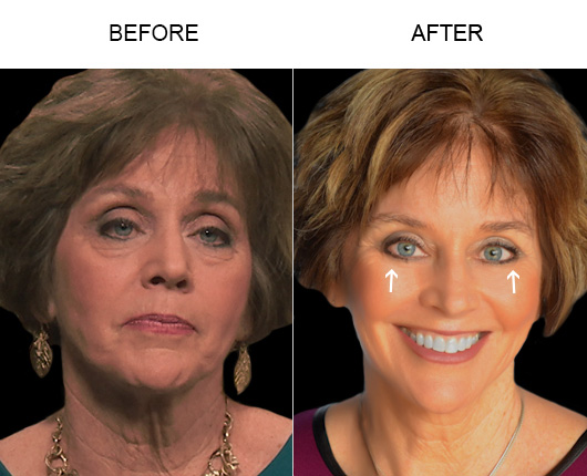 Eyelid Surgery Before & After