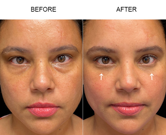 Lower Eyelid Surgery Before And After Lower Eyelid Surgery Before And After