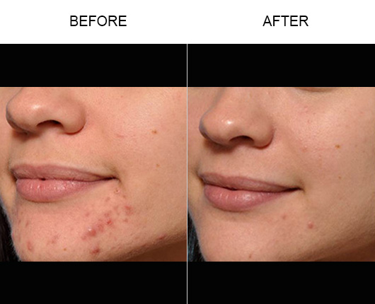 Microneedling & PRP Before and After Microneedling & PRP Before and After