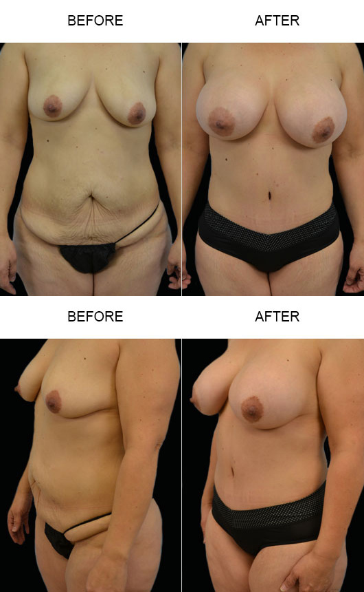 Before And After Mommy Makeover Before And After Mommy Makeover