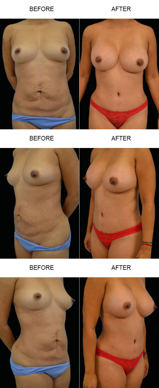 Mommy Makeover Before And After Mommy Makeover Before And After