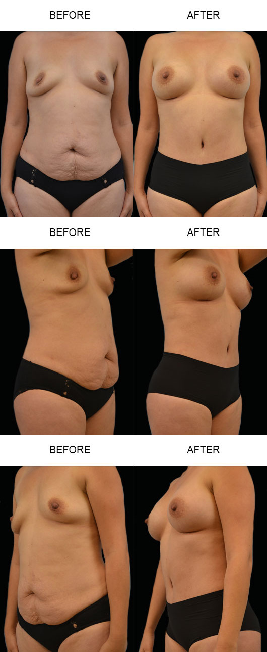Mommy Makeover Before & After Mommy Makeover Before & After