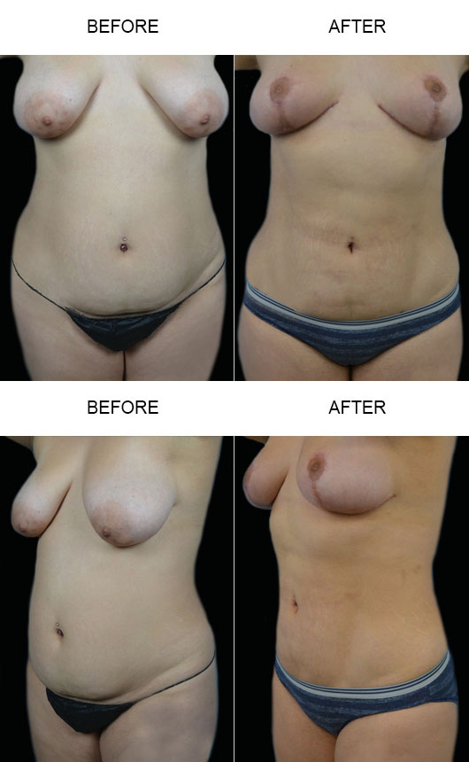 Before & After Mommy Makeover Before & After Mommy Makeover