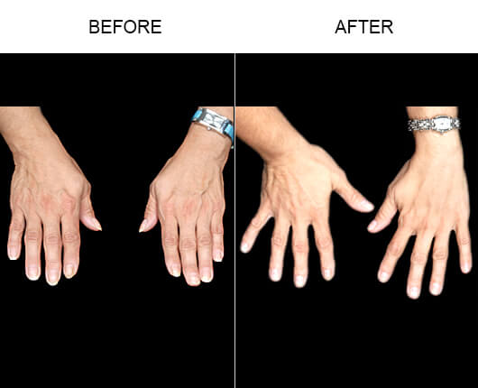 Natural Hand Rejuvenation Before And After