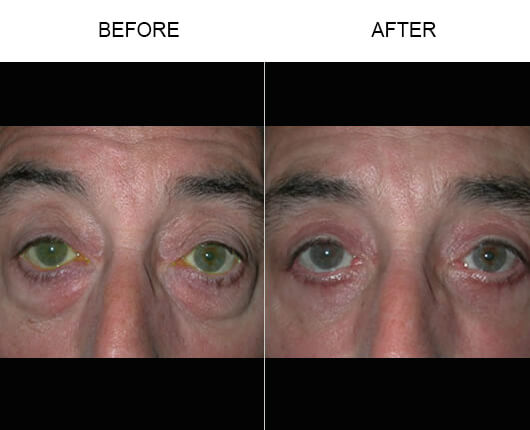 Eyelid Ptosis Surgery Before And After