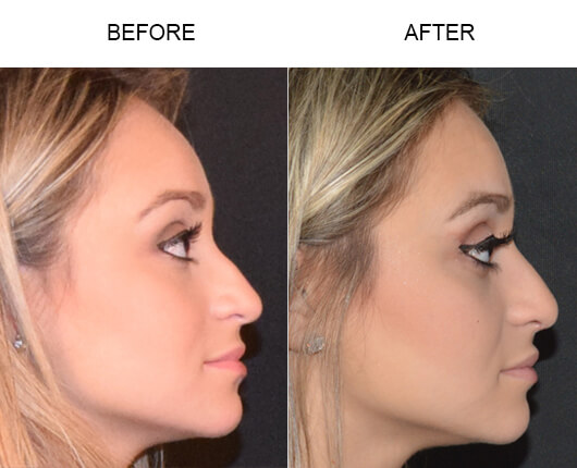 Tampa Rhinoplasty Surgery Before & After