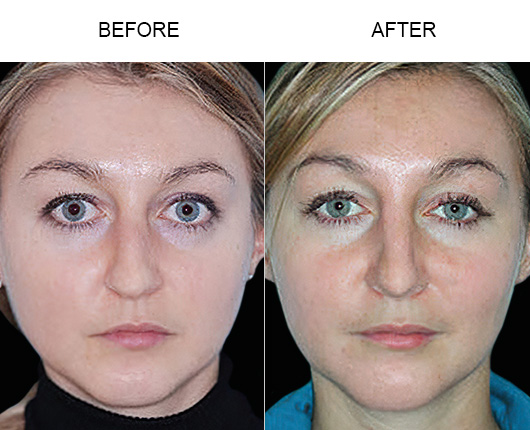 Florida Rhinoplasty Results