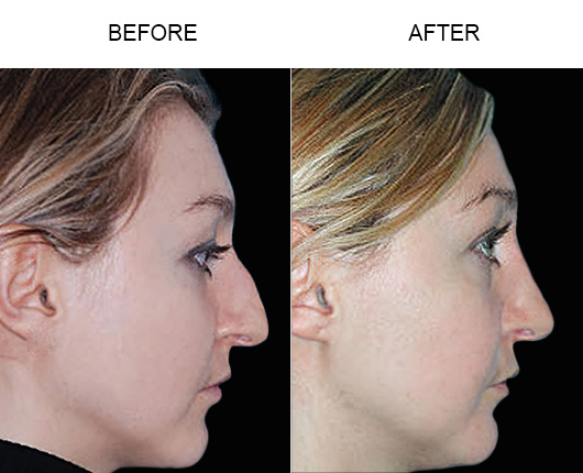 Before & After Rhinoplasty