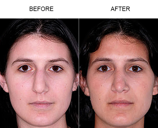 Rhinoplasty Surgery Before & After