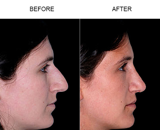 Before And After Rhinoplasty Surgery