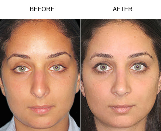 Upturned Nose – Rhinoplasty Orlando Nose Job