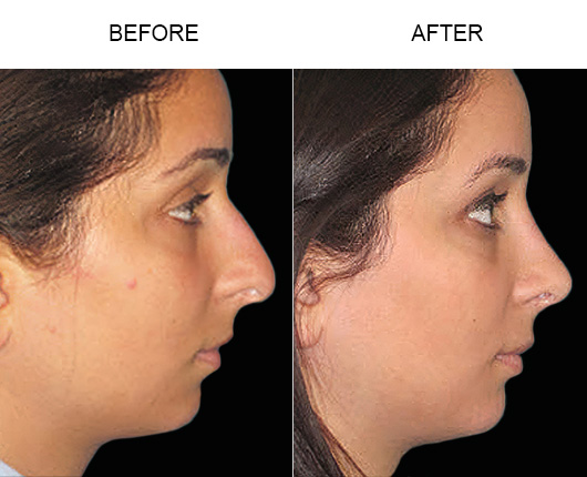 Rhinoplasty Before & After