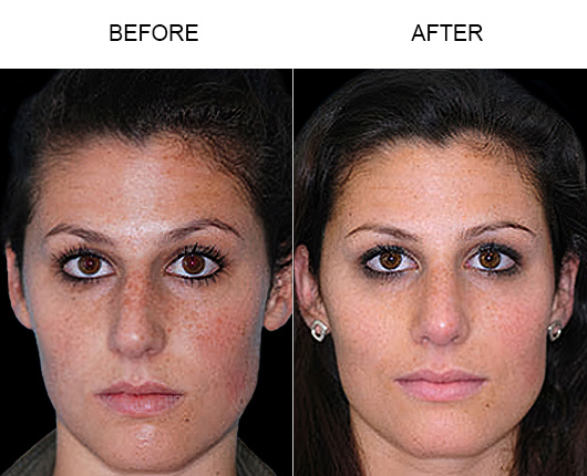 Rhinoplasty Surgery Orlando