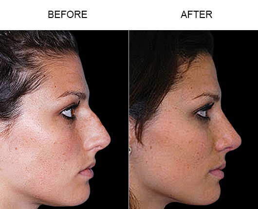 Before And After Rhinoplasty Orlando