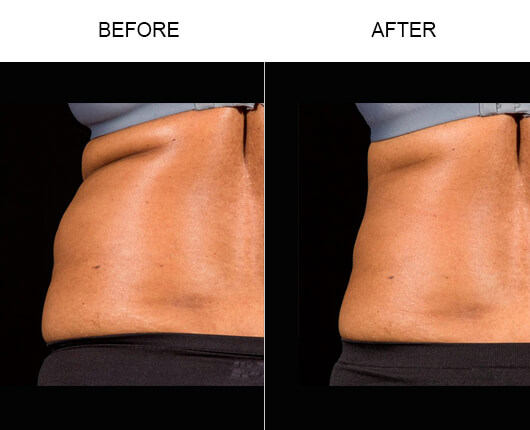 Laser Fat Removal Before And After