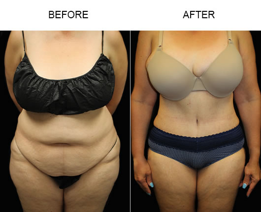 Tummy Tuck Before And After