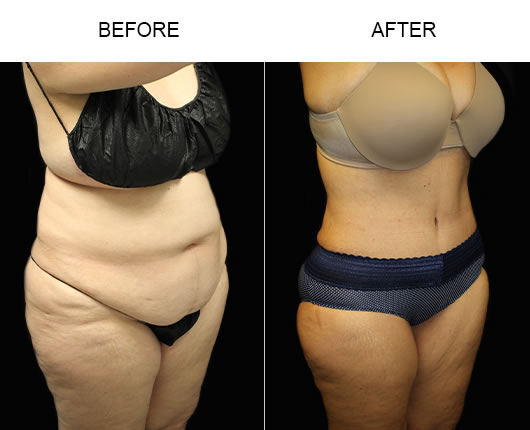 Tummy Tuck Before & After