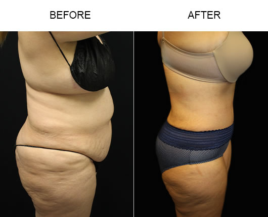 Before And After Tummy Tuck