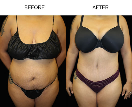 Before & After Tummy Tuck