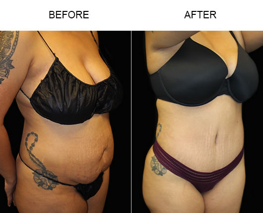 Tummy Tuck Results