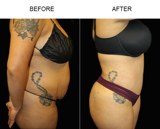 Tummy Tuck Surgery Before And After