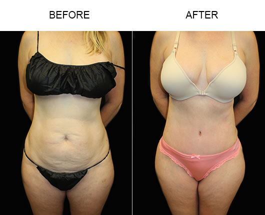 Tummy Tuck Surgery Before & After