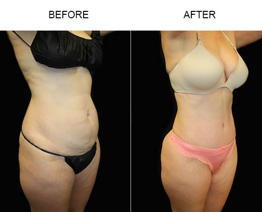 Before And After Tummy Tuck Surgery