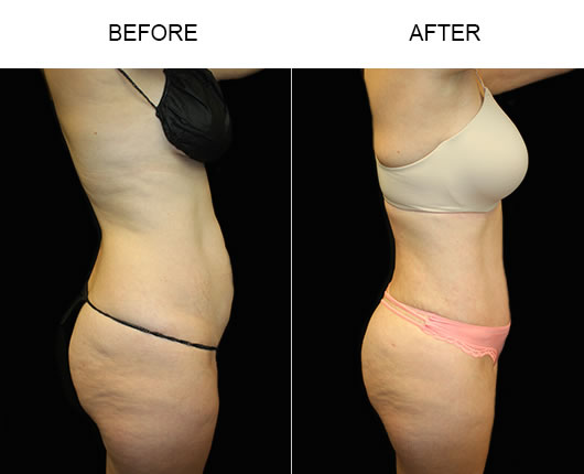 Tummy Tuck in Tampa  Abdonimoplasty in Tampa