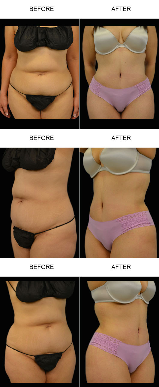 Tummy Tuck Before And After Tummy Tuck Before And After