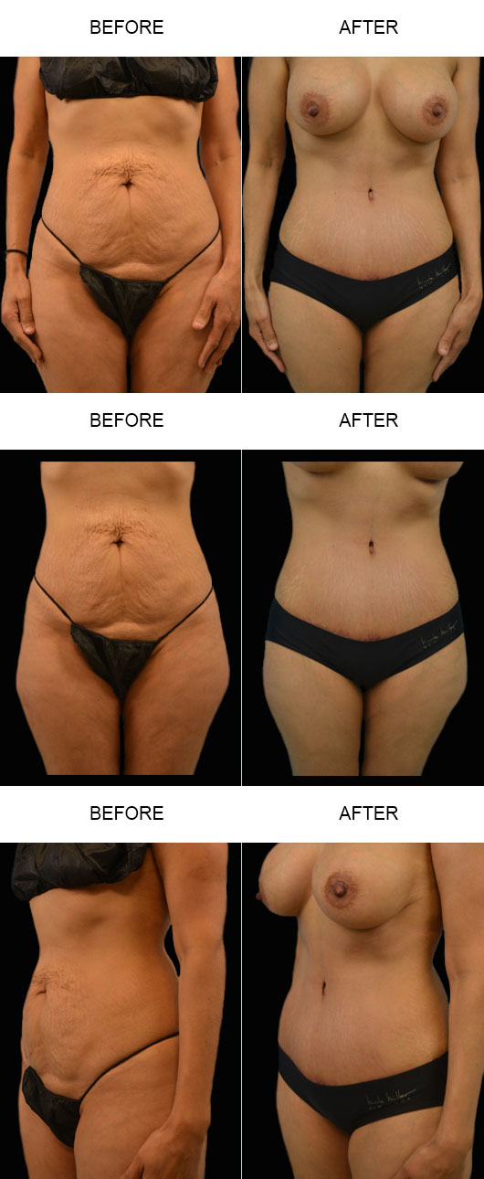 Tummy Tuck Before & After Tummy Tuck Before & After