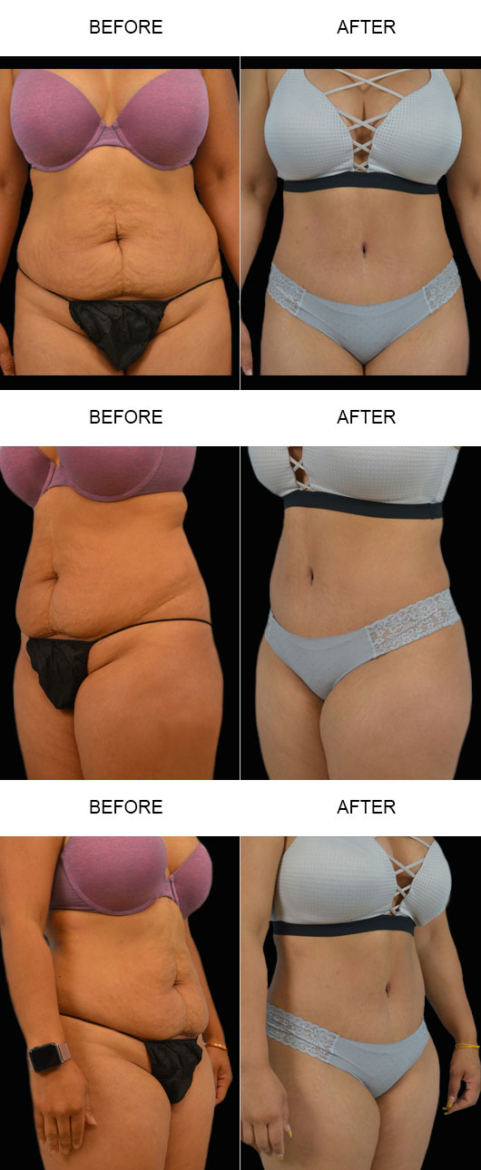 Before And After Tummy Tuck Before And After Tummy Tuck