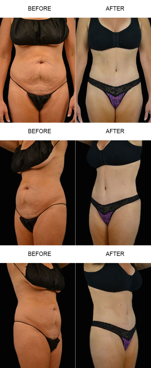 Before & After Tummy Tuck Before & After Tummy Tuck