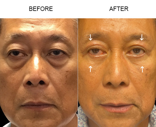 Lower Eyelid Surgery Before And After