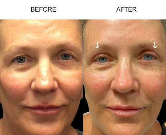 Upper Eyelid Surgery Before And After