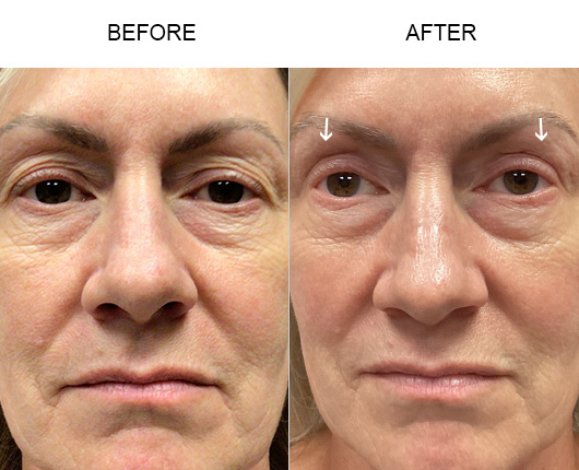 Blepharoplasty Before And After