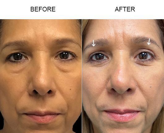 Upper Eyelid Surgery Before & After