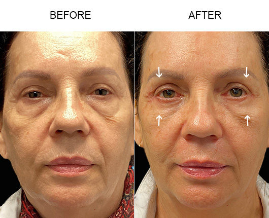 Lower Eyelid Surgery Before And After