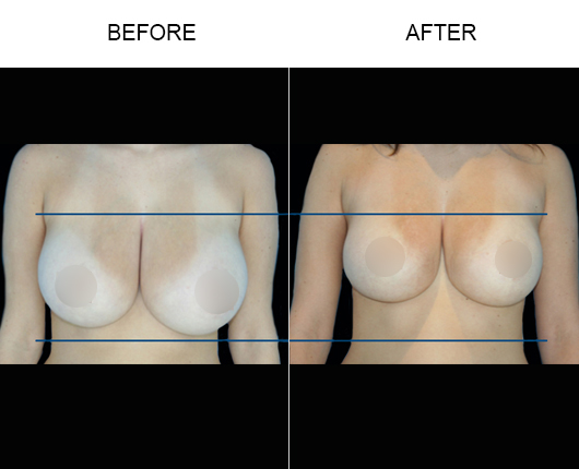 Non-Surgical Breast Lift Before & After Non-Surgical Breast Lift Before & After