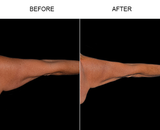 Bodytite Surgery For Arms Before And After