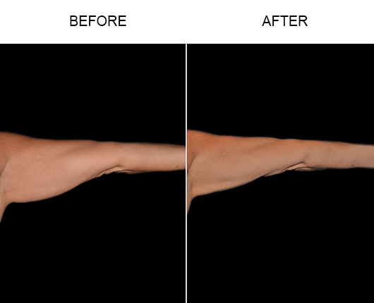 Bodytite Orlando  Radio Frequency Skin Tightening