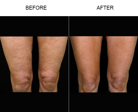 Bodytite Orlando | Radio Frequency Skin Tightening