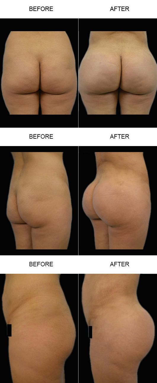 Brazilian Butt Lift Before And After Brazilian Butt Lift Before And After