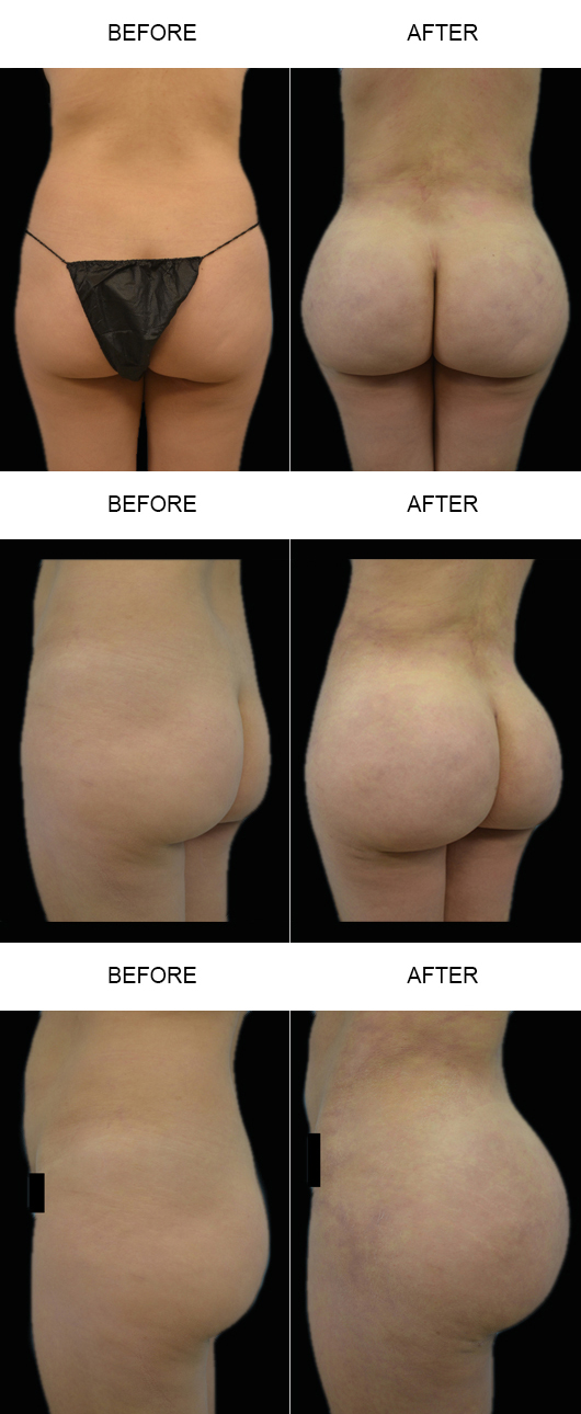 Before And After Brazilian Butt Lift Before And After Brazilian Butt Lift