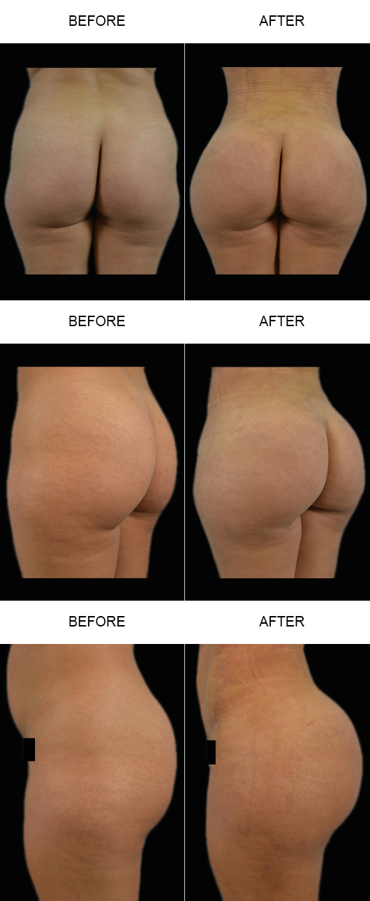 Before & After Brazilian Butt Lift Before & After Brazilian Butt Lift