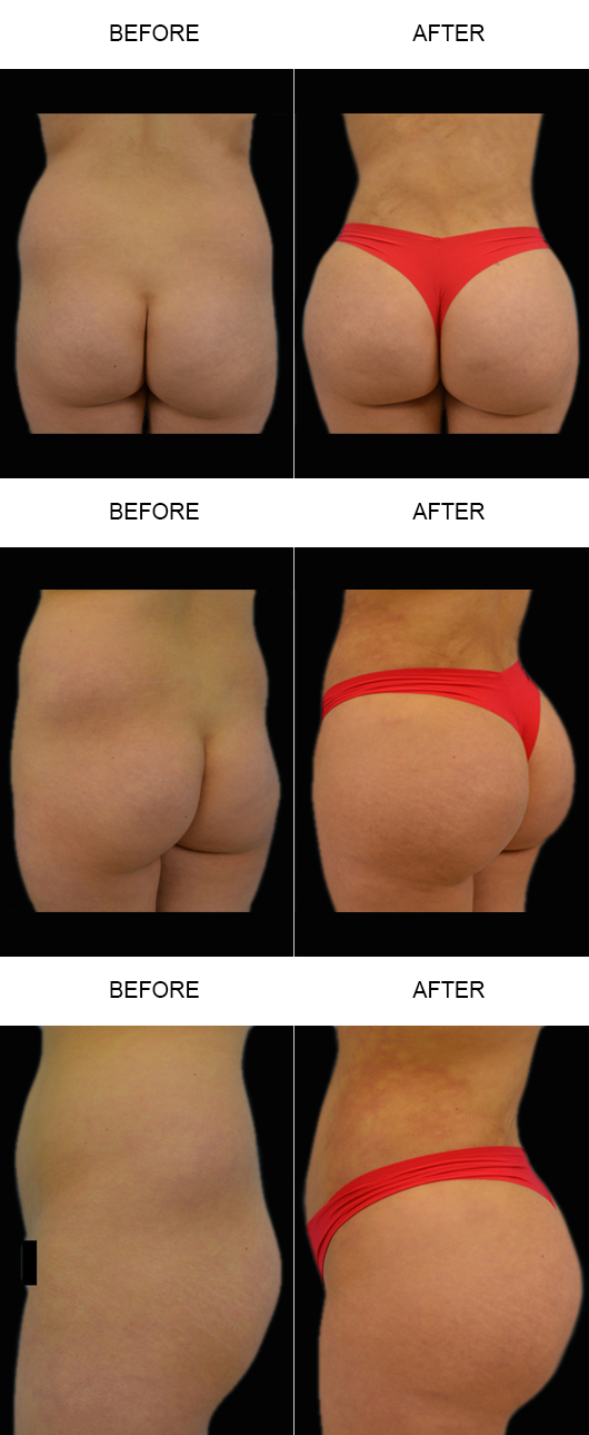 Brazilian Butt Lift Before & After Brazilian Butt Lift Before & After