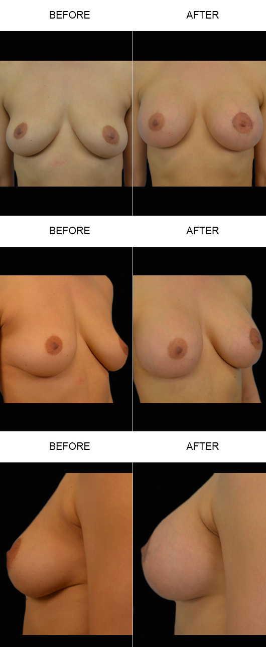 Breast Augmentation Before And After Breast Augmentation Before And After