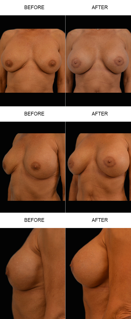 Breast Augmentation Before & After Breast Augmentation Before & After