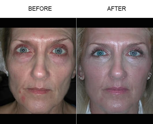 Cheek Lift Before And After