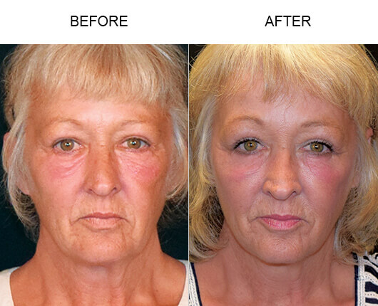 Cheek Lift Results